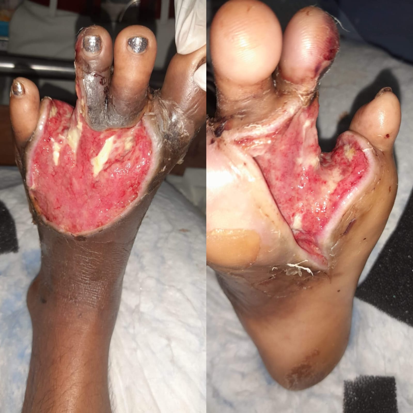 Before VAC Dressing – Case 1