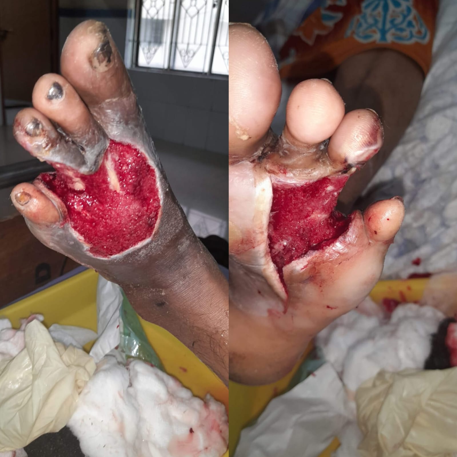 After VAC Dressing – Case 1